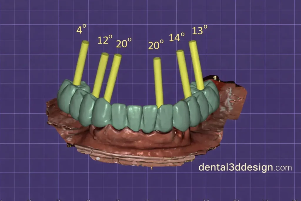 Exocad file All-on-6 implant prosthesis - 3D digital design Dental3DDesign
