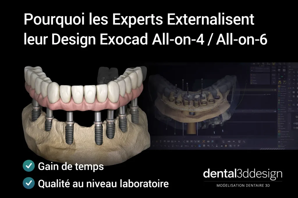 Design Exocad All-on-4 All-on-6 externalisé pour implantologie dentaire