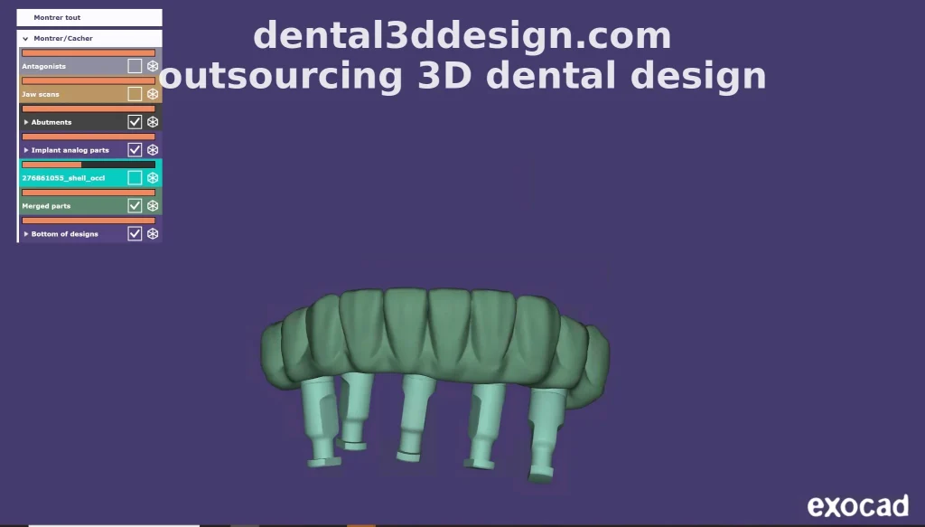 Outsourcing 3D dental design Exocad for implant dentistry – Dental3DDesign