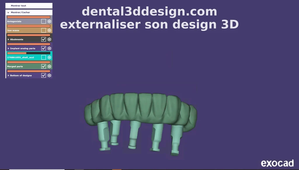Externalisation design 3D dentaire Exocad pour implantologie All-on-4 et All-on-6 – Dental3DDesign