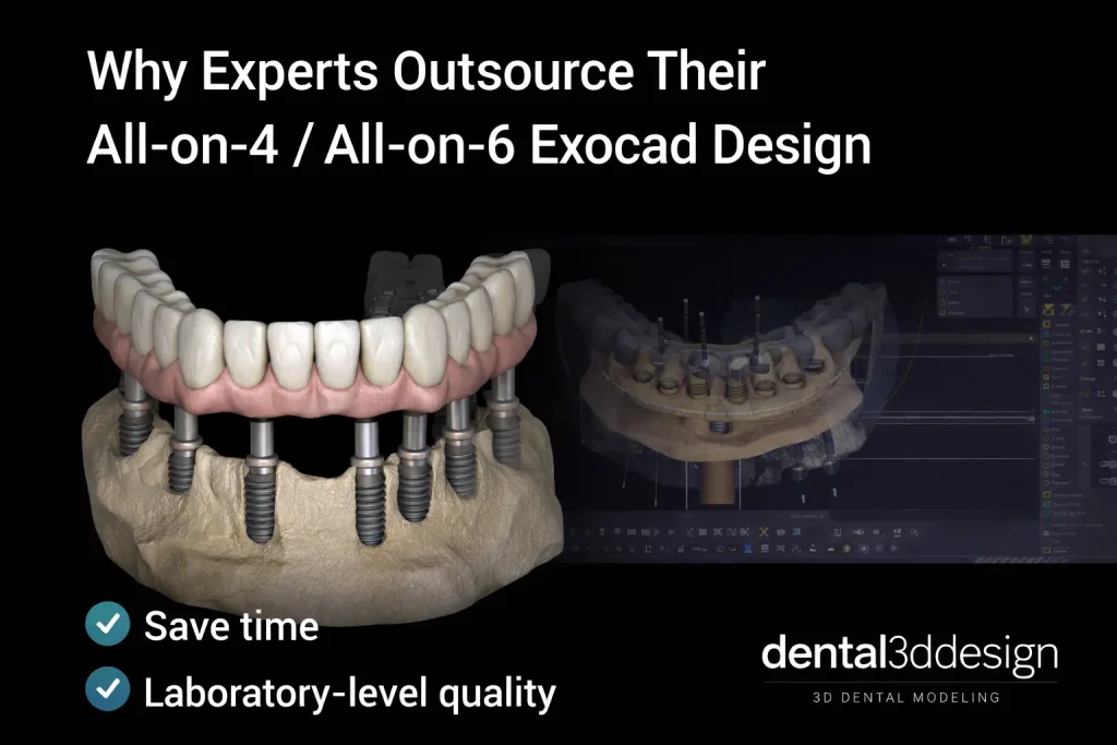 Outsourced Exocad All-on-4 All-on-6 dental implant design illustration